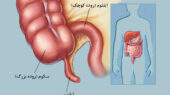آپاندیس